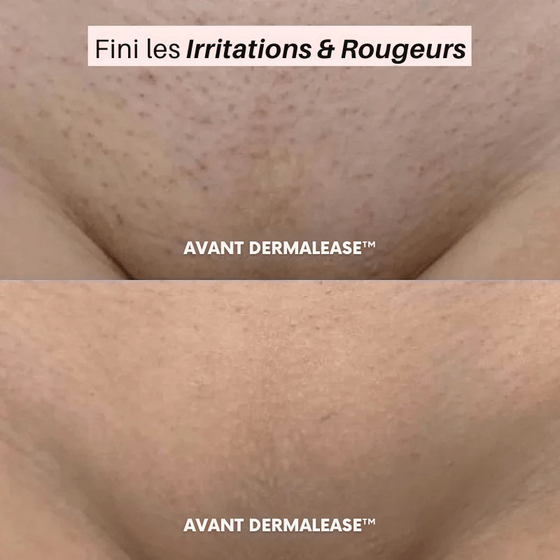 DermalEase™ - Luméa Swiss - Québec