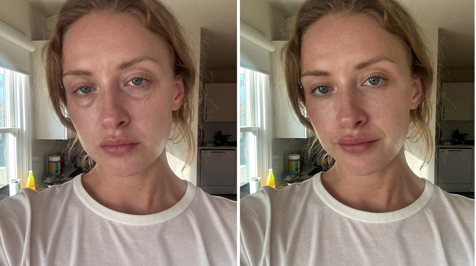 Avant apres drainage lymphatique du visage